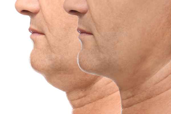HIFU - Breakthrough in Anti - ageing 2 hifu results Deal