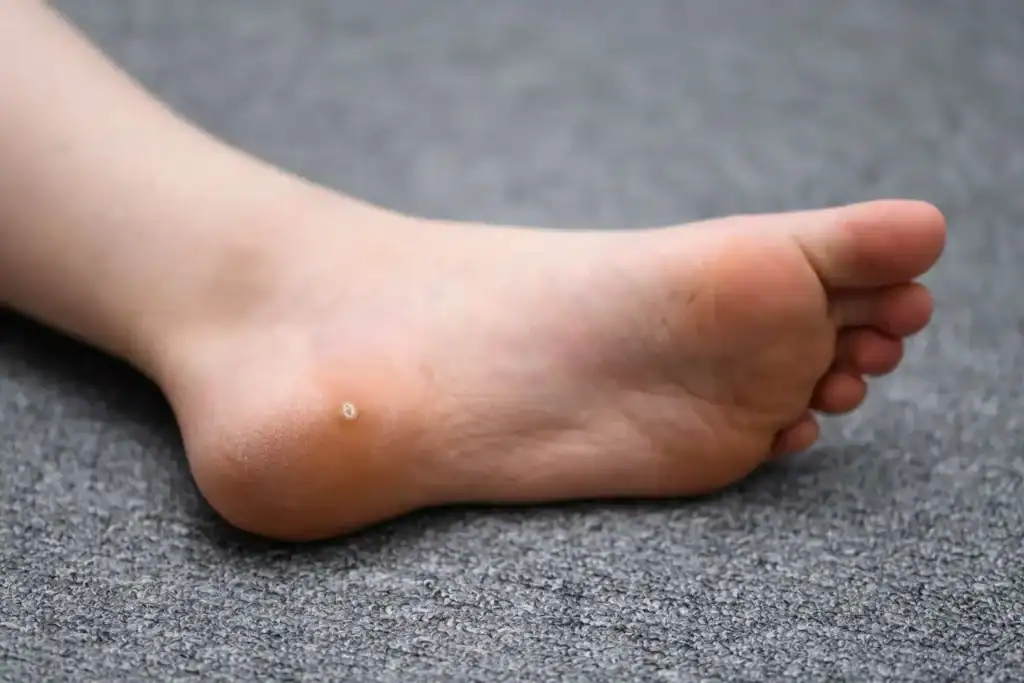 Cryotherapy For Warts And Also Verrucas 2 Image of verruca on the bottom of the foot that able to be treated with Cryotherapy Deal