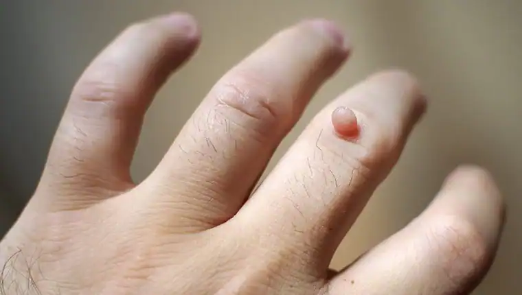 Image of blemish that Cryotherapy Deal can remove with Lipo 360.