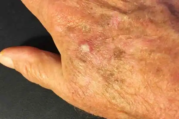 Image of Actinic keratoses Deal on a person hand