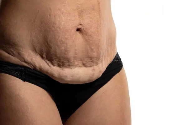 The science behind skin tightening Deal picture of a woman's sagging skin on the stomach